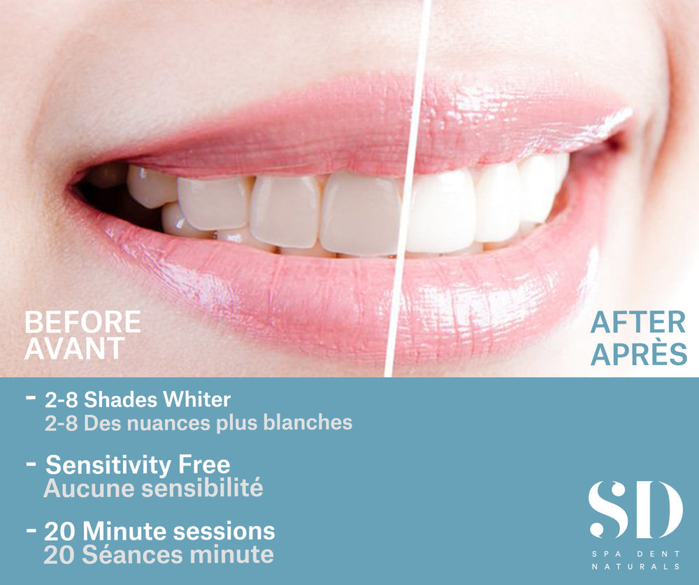 SpaDent Naturals A125200 Home Whitening Kit (Non-LED) - Case of 5