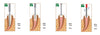 Diadent 4007-2121 GP Obturation Tips (25G, 4/Box)